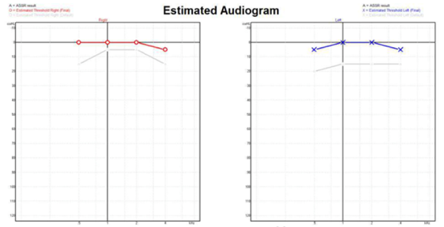 assr hearing test, auditory steady-state response (assr)