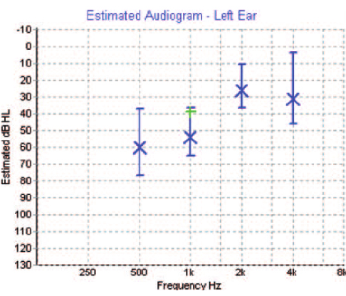 assr hearing test, auditory steady-state response (assr)